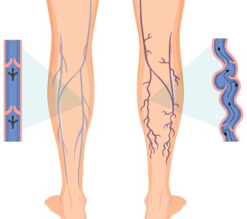 روش درمان بیماری واریس | کفش مناسب درمان واریس